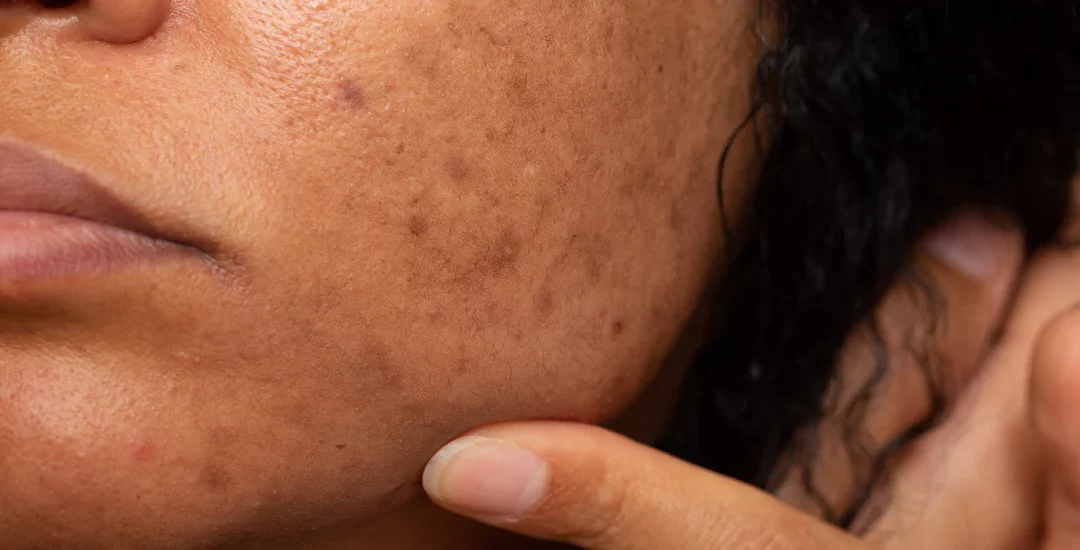 What Causes Pigmentation – and How Can You Fade It?