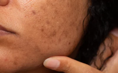 What Causes Pigmentation – and How Can You Fade It?