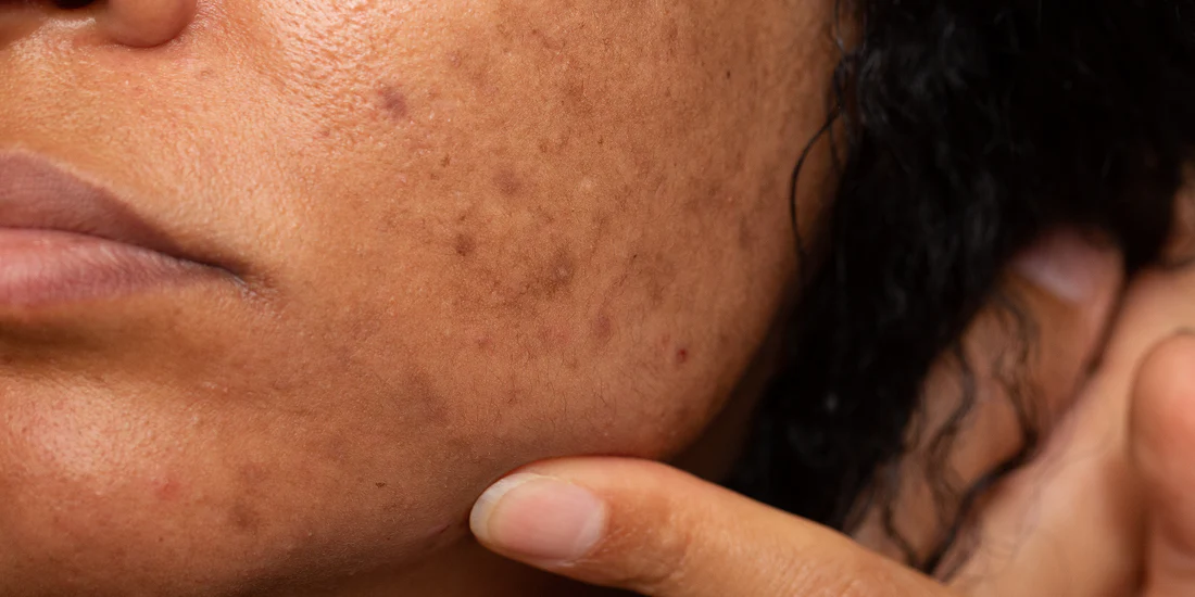 What Causes Pigmentation – and How Can You Fade It?