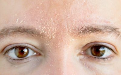 Cracked Lips, Red Cheeks: How to Soothe Cold Weather Sensitivity