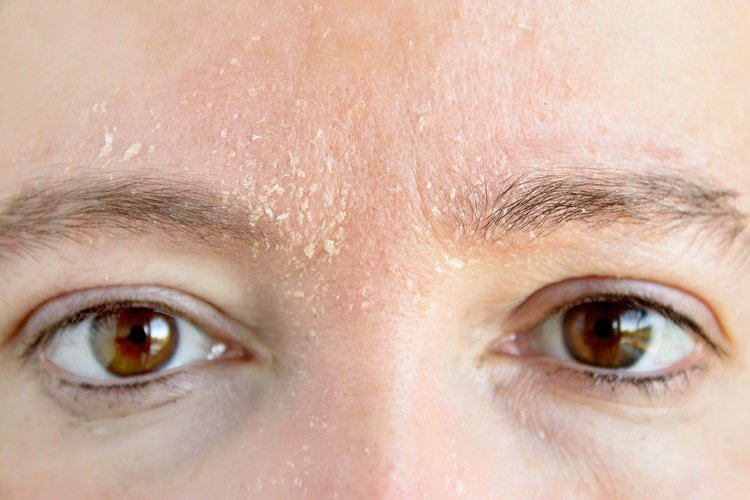 Cracked Lips, Red Cheeks: How to Soothe Cold Weather Sensitivity